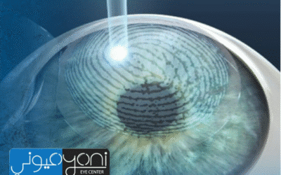 LASIK Eye Surgery Dubai Offers: What to Look for Before Choosing Your Eye Surgeon