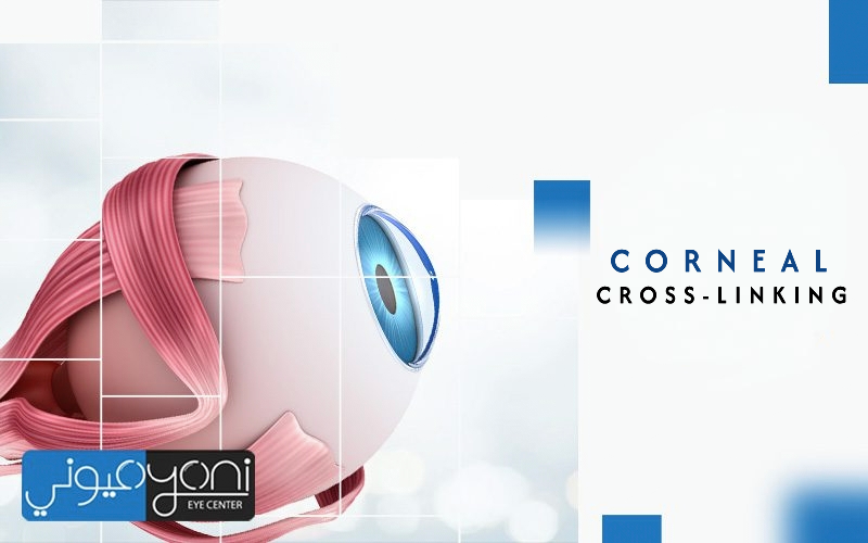 Corneal Cross-Linking Surgery