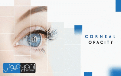Corneal opacity