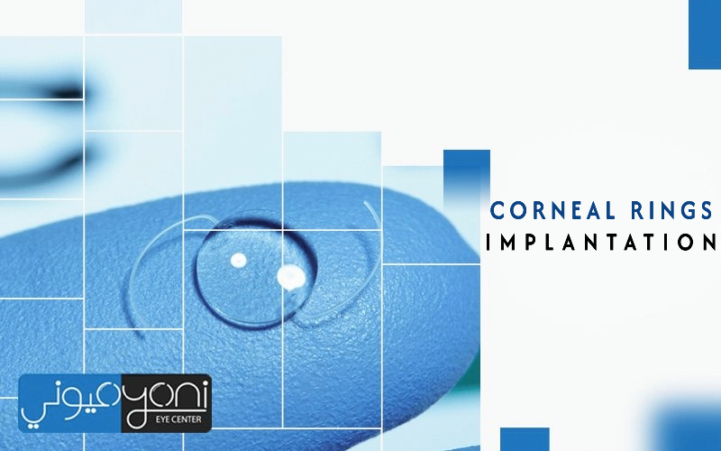 Corneal Ring Implantation