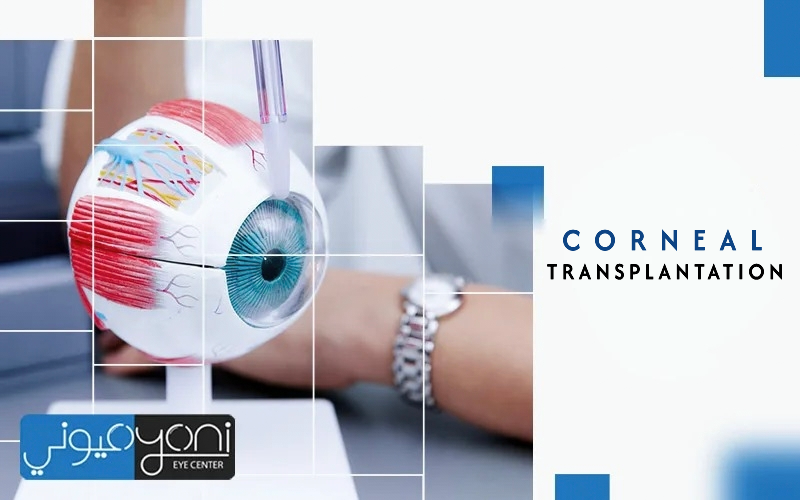 Corneal Transplant (Full / Partial)