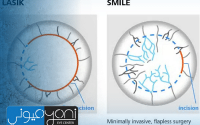 Femto LASIK vs ReLEx SMILE: How to Choose the Right Laser Eye Surgery for Your Vision