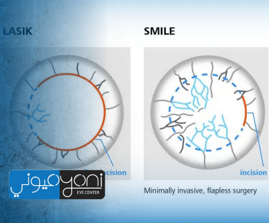 Femto LASIK vs ReLEx SMILE: How to Choose the Right Laser Eye Surgery for Your Vision