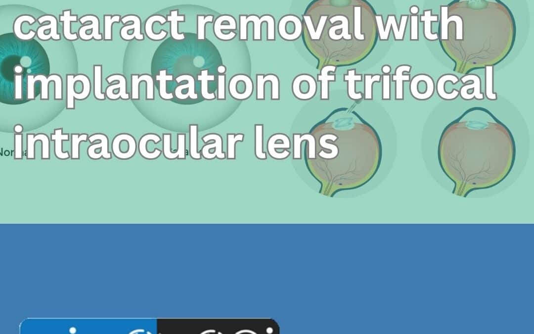 Cataract Removal With Implantation of Trifocal Intraocular Lens to Get Rid Off the Glasses for Far and Near