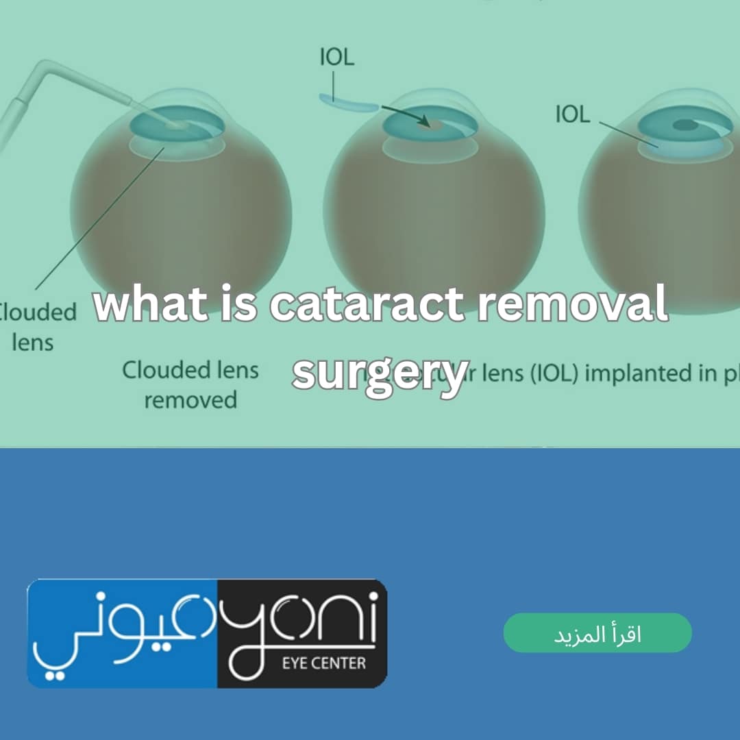 what is cataract removal surgery