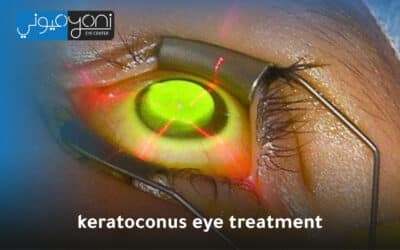 Keratoconus Eye Treatment