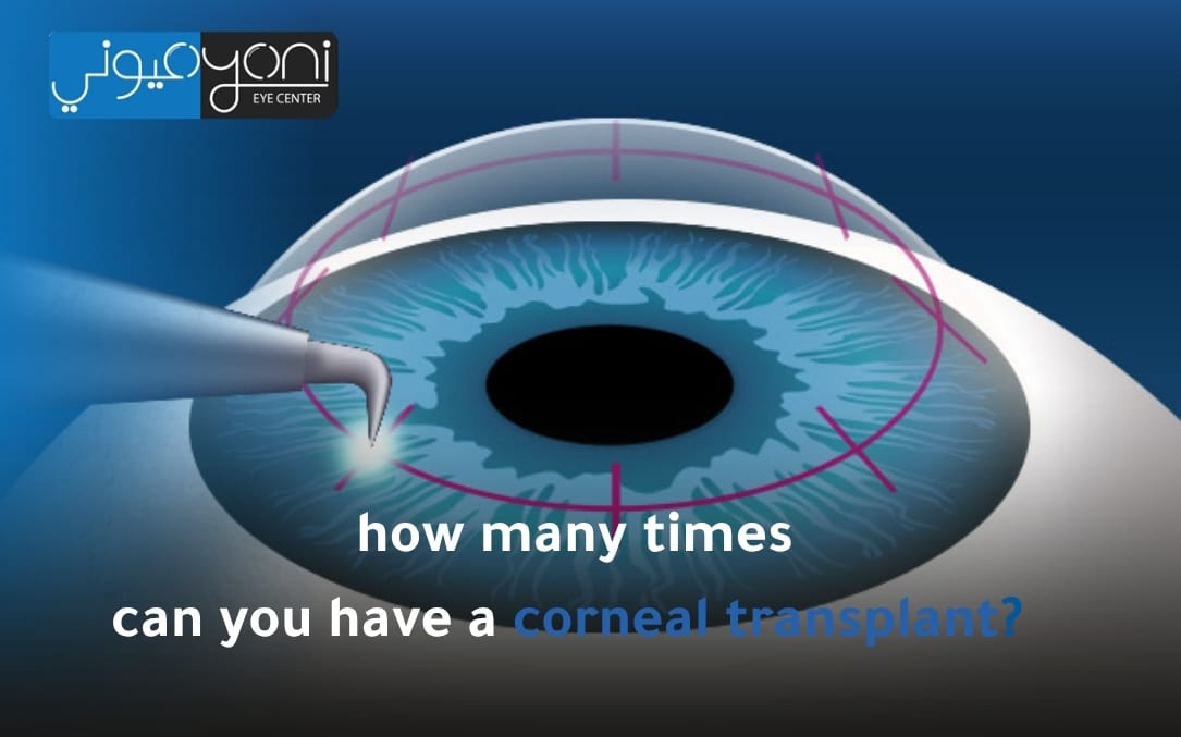 trifocal lenses surgery cost