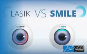 difference between femto lasik and smile pro