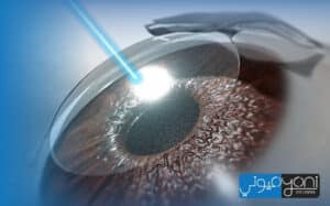 femto lasik vs lasik recovery time
