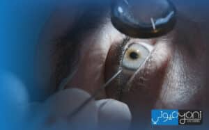keratoconus eye treatment