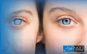 what are the disadvantages of cataract surgery