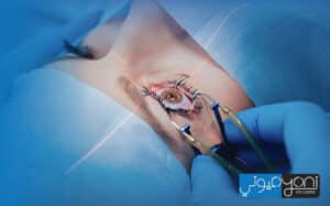 types of cataract surgery and cost