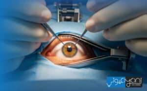 cost of cataract surgery with corrective lenses