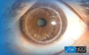 how many times can you have a corneal transplant