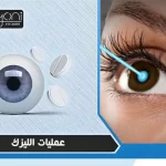 عمليات الليزك والفيمتو ليزك والفيمتو سمايل LASIK, Femto-LASIK, and Femto-Smile