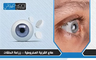 علاج القرنية المخروطية – زراعة الحلقات