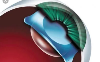 لماذا قد تحتاج إلى زراعة العدسة ؟