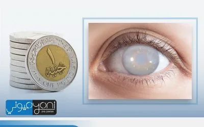 سعر عملية المياه البيضاء في العين