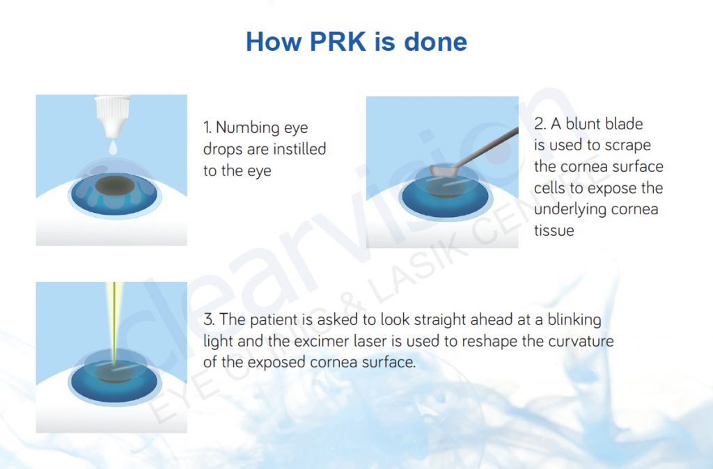 how prk is done steps