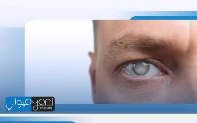 اعراض نزول الماء الابيض في العين.. ما بين ضبابية الرؤية وبهتان الألوان