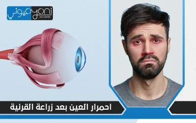 هل احمرار العين بعد عملية زراعة القرنية دليلًا على فشل الجراحة؟