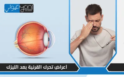 اعراض تحرك القرنية بعد الليزك