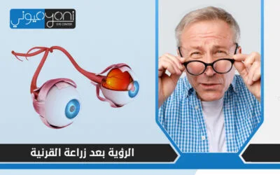 متى تتحسن الرؤية بعد زراعة القرنية؟