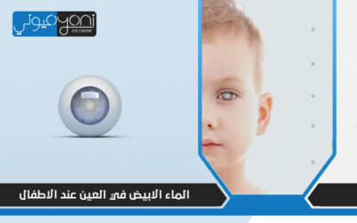 هل ينتقل الماء الابيض في العين عند الاطفال وراثيًا؟