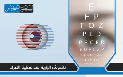 التخلص من تشوش الرؤية بعد عملية الليزك و نصائح لتقليل فترة التعافي