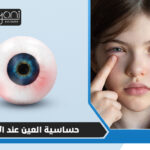حساسية العين عند الاطفال