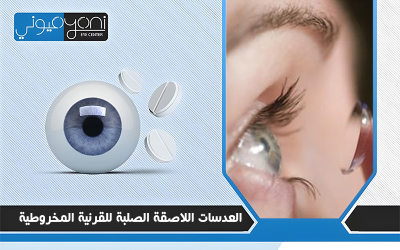 العدسات اللاصقة الصلبة للقرنية المخروطية