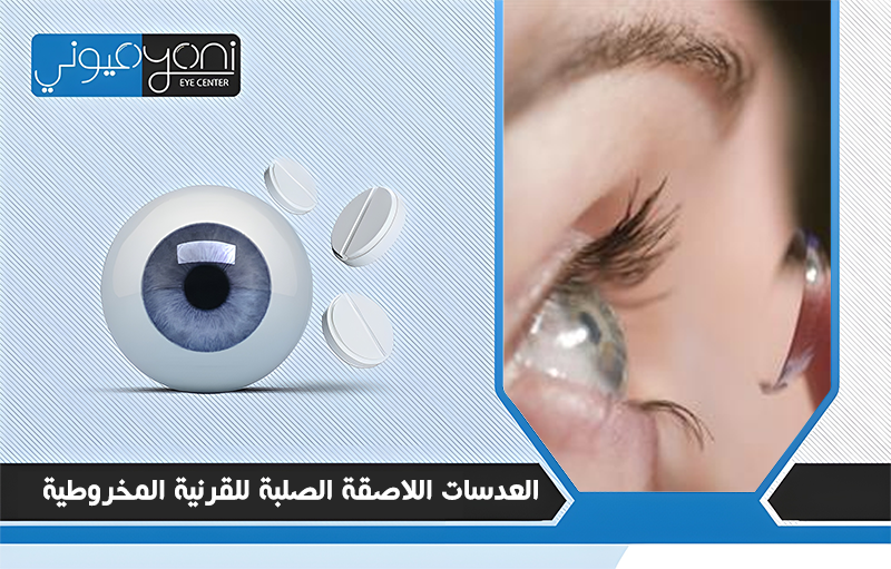 العدسات اللاصقة الصلبة للقرنية المخروطية