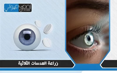 زراعة العدسات الثلاثية