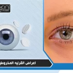 اعراض القرنيه المخروطيه