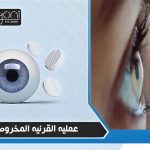 عمليه القرنيه المخروطيه
