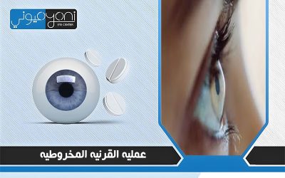 عمليه القرنيه المخروطيه