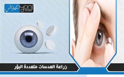 زراعة العدسات متعددة البؤر
