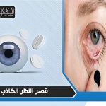 قصر النظر الكاذب