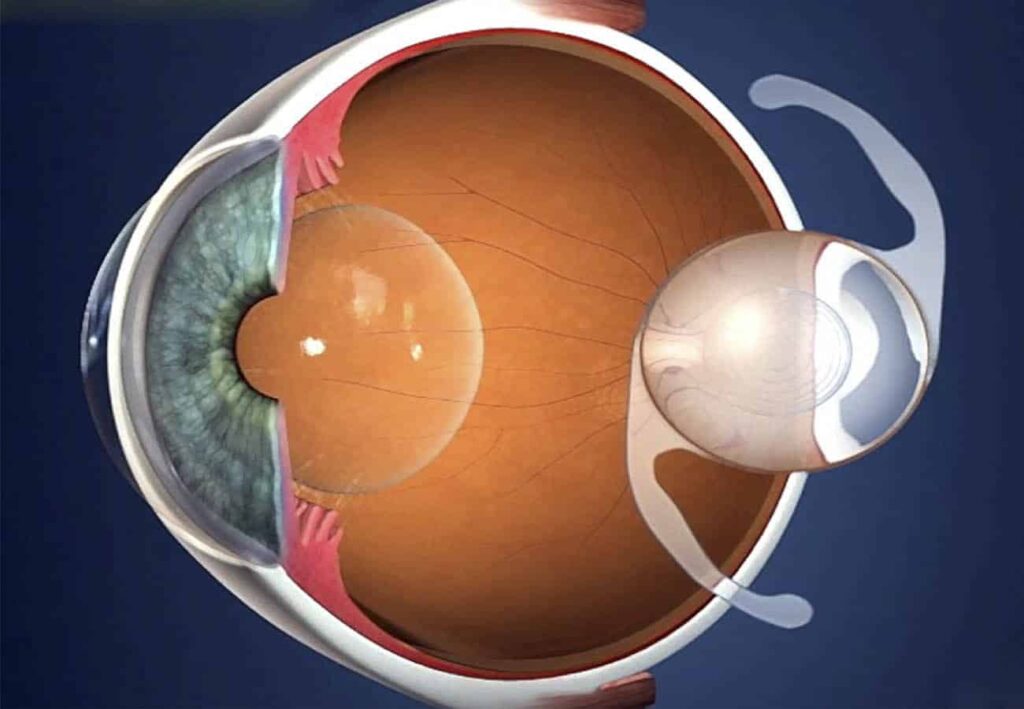 أفضل دكتور زراعة عدسات في مصر أفضل دكتور زراعة عدسات في مصر
