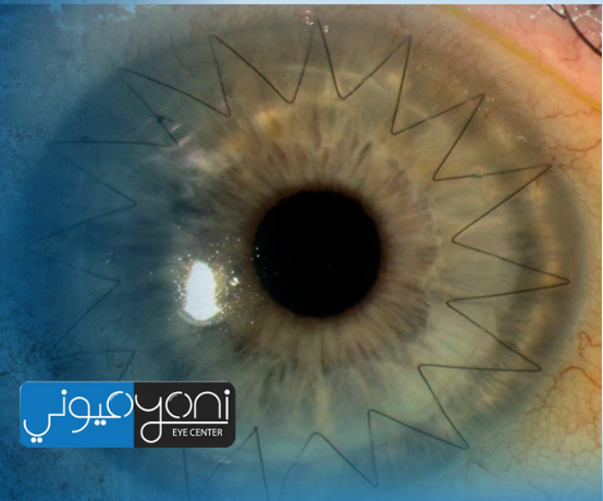 What Is Corneal Transplant Surgery? A Complete Guide for Patients