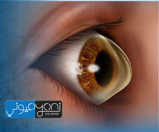 القرنيه المخروطيه اسبابها وعلاجها… دليلك الشامل مع خبرة دكتور طارق عبدالسميع في دبي