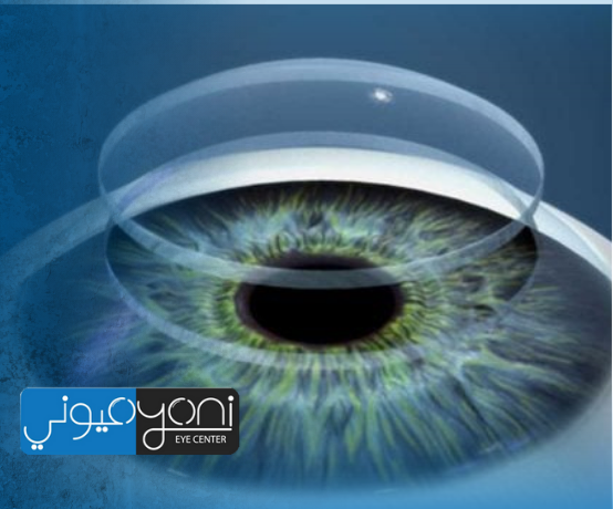 تجربتي مع زراعة الحلقات للقرنية المخروطية