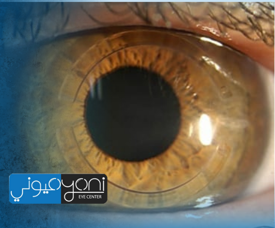 تجربتي مع زراعة القرنيه في دبي مع دكتور طارق عبدالسميع