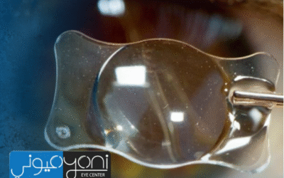 ايهما افضل زراعة العدسات ام الليزك