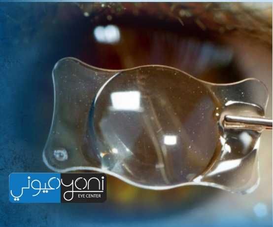 ايهما افضل زراعة العدسات ام الليزك