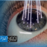 هل عملية الفيمتو ليزك مؤلمة