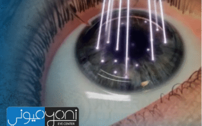 هل عملية الفيمتو ليزك مؤلمة