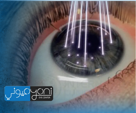 دكتور طارق عيوني (2) هل عملية الفيمتو ليزك مؤلمة