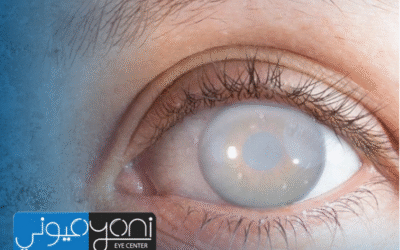 المياة البيضاء وعلاجها