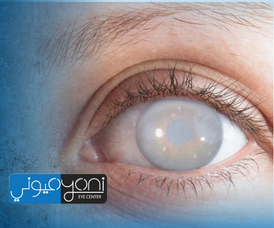 المياة البيضاء وعلاجها